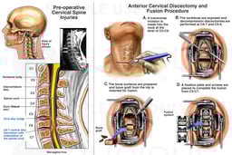 Post-collision Neck Injuries with Anterior Cervical Discectomy and Fusion