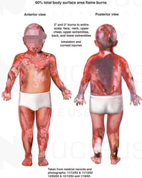 Severe Burn Injuries - Pediatric