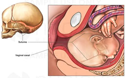 Fetal Head Molding