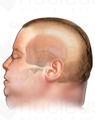 Lateral Head and Skull of Obese White Male