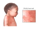 Prickly Heat Rash