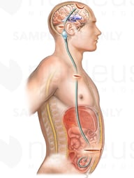 Brain Shunt Overview