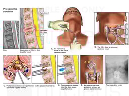 Cervical Spine Injury with Surgical Arthrodesis