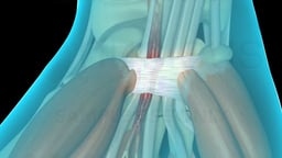 Carpal Tunnel Syndrome with Surgical Release (compressed version)