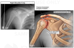 Right Shoulder Injuries