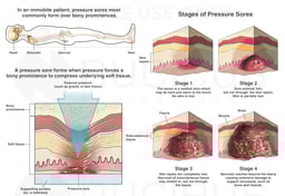 Formation of a Pressure Sore (Bedsore or Decubitus Ulcer)