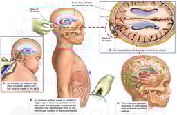 Placement of Ventricular Shunt for Hydrocephalus with Subsequent Infection
