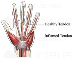 Tendonitis of the Hand