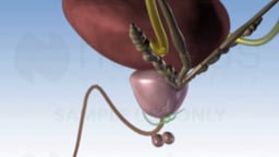 Prostatectomy Surgery (Prostate Gland Removal)