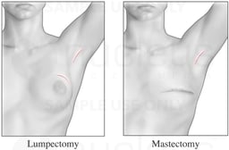 Lumpectomy and Mastectomy - Appearance After Surgery