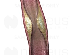 Buildup Inside Artery