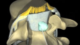 Epidural Steroid Injection (Abbreviated Version)