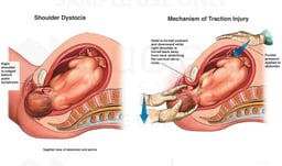 Traction Injury During Delivery with Cervical Nerve Damage