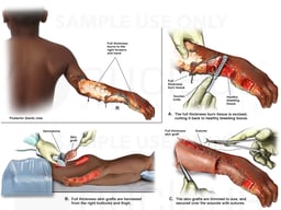 Burn Excision and Skin Grafting