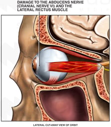 Post-accident Injuries to the Optic Nerve, Abducens Nerve (Cranial Nerve VI) and Lateral Rectus Eye Muscle