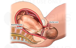 Birth Injury - Shoulder Dystocia with Right Brachial Plexus Injury Caused by Sacrum
