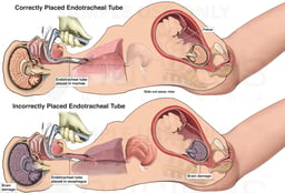 Esophageal Intubation with Subsequent Hypoxic Brain Injury
