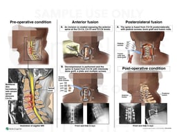 Cervical Disc Injuries with Surgical Fusion Procedures