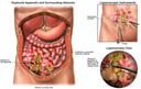 Laparoscopic Drainage of Peritoneal Abscess