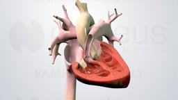 Understanding Tetralogy of Fallot