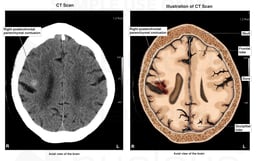 Brain Injury