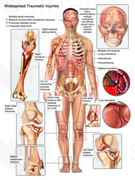 Male figure with Brain Injury, Damage to the Spleen and Liver, and Fractures of the Arm and Legs Bilaterally