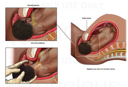 Shoulder Dystocia with Brachial Plexus Injury