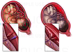 Placental Abruption with Interruption of Fetal Circulation