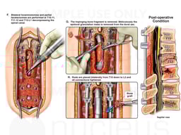 Third Spine Surgery (Part 2): Surgical Decompression and Stabilization of Pseudoarthrosis