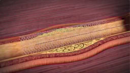 How Does an Angioplasty Open Arteries in the Heart?