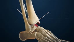 Arthroscopic Ankle Fusion