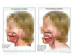 Left Subtotal Glossectomy