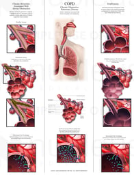 COPD: Chronic Obstructive Pulmonary Disease