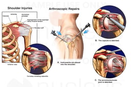 Left Shoulder Capsulitis and Impingement with Initial Arthroscopic Repairs