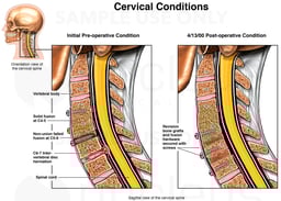 Cervical Conditions
