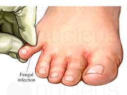 Interdigital Athlete's Foot