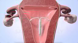 How Does an IUD Prevent Pregnancy?