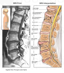 Multilevel Thoraco-Lumbar Spine Injuries with Compression Fractures and Disc Injuries
