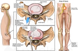 Lumbar Discectomy and Subsequent Nerve Damage