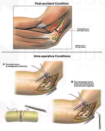 Ulnar Nerve Injury with Surgical Repair