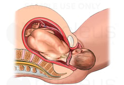 Birth Injury - Shoulder Dystocia with Right Brachial Plexus Injury Caused by Sacrum