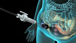 Laparoscopic Access to the Abdominal Cavity