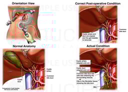 Surgical Removal of the Gall Bladder with Damage to the Common Bile Duct