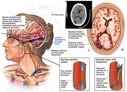 Female Head with Post-accident Brain Injuries and Arterial Dissection