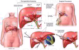 Proper Surgical Removal of the Gall Bladder