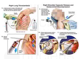 Surgeries (Right Lung Thoracentesis and Right Shoulder Decompression)