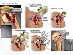 Left Humeral Neck Fracture with Surgical Repair
