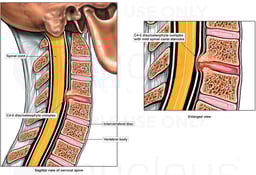 C4-C5 Cervical Spine Injury
