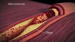 Plaque Highlighted in Atherosclerosis