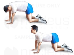 Ankylosing Spondylitis: Arch and Sway